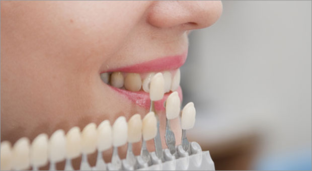 dental veneers, dental treatment